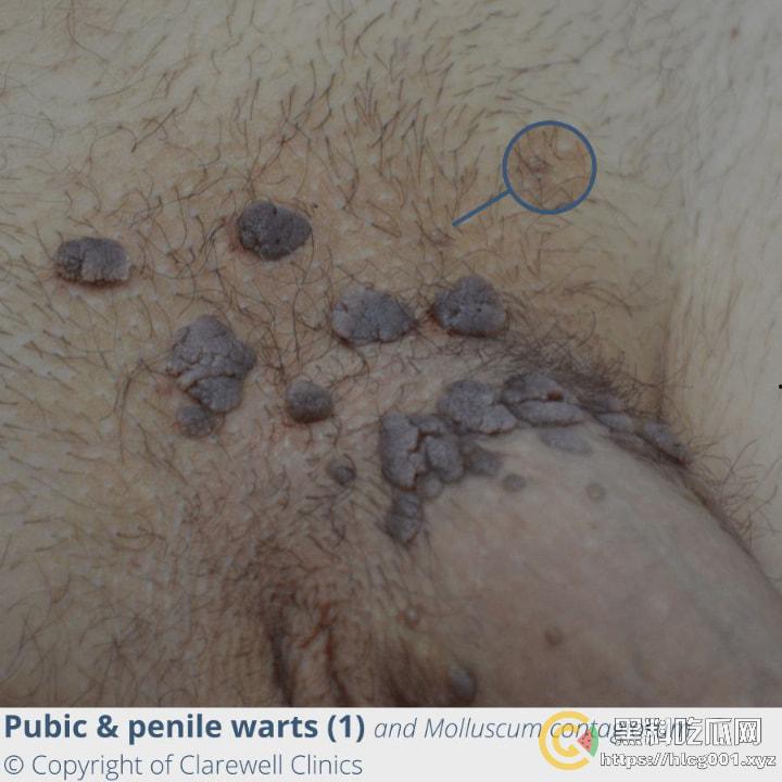 性病篇  谨慎观看！瓜友们出门在外 一定得洁身自爱 世界上没有后悔药  安全第一！！！ （二）-7