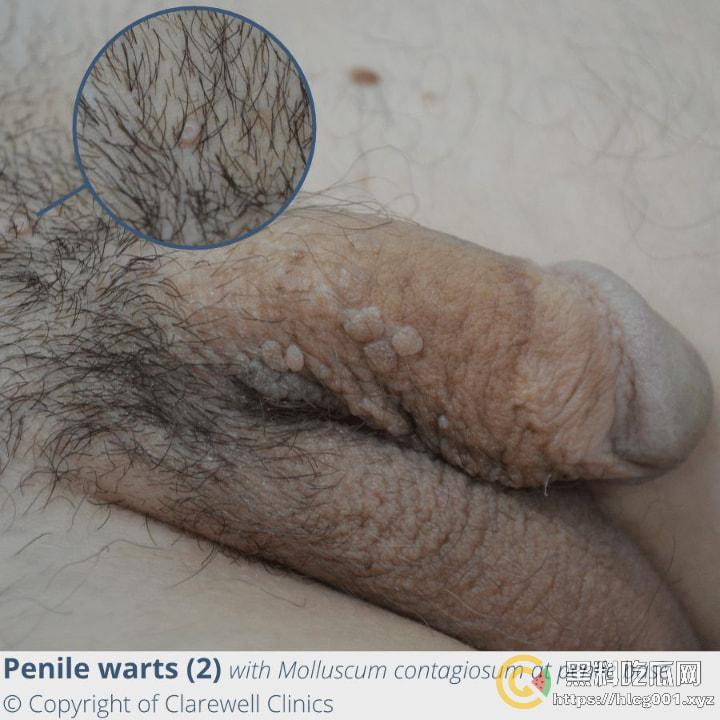 性病篇  谨慎观看！瓜友们出门在外 一定得洁身自爱 世界上没有后悔药  安全第一！！！ （二）-10