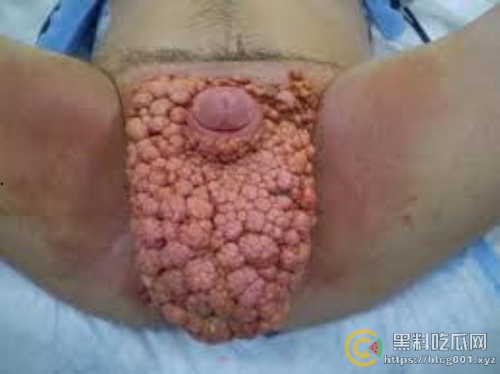 性病篇  谨慎观看！瓜友们出门在外 一定得洁身自爱 世界上没有后悔药  安全第一！！！ （二）-18