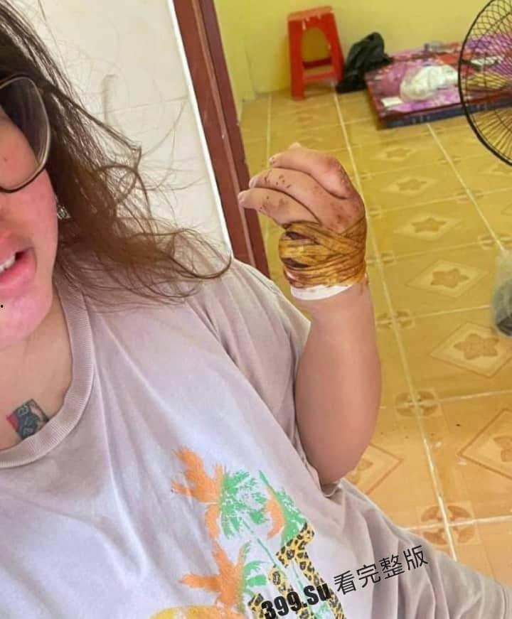 中国女孩王某被人诱骗到柬埔寨 后遭越南人绑架 被切掉一根 手指,并拍摄下视频威胁其国内家人勒索500万-6