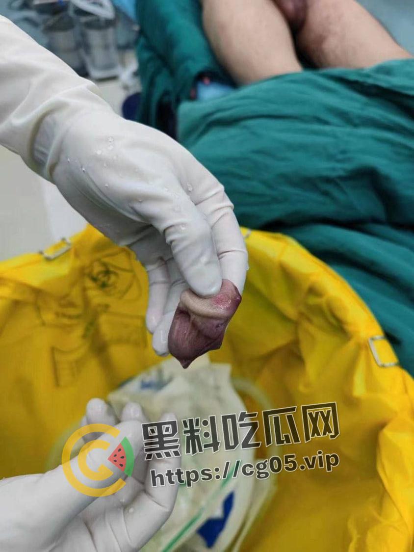 神医在世！ 鸡鸡被女友咬断都能接回去 还不影响性功能-1