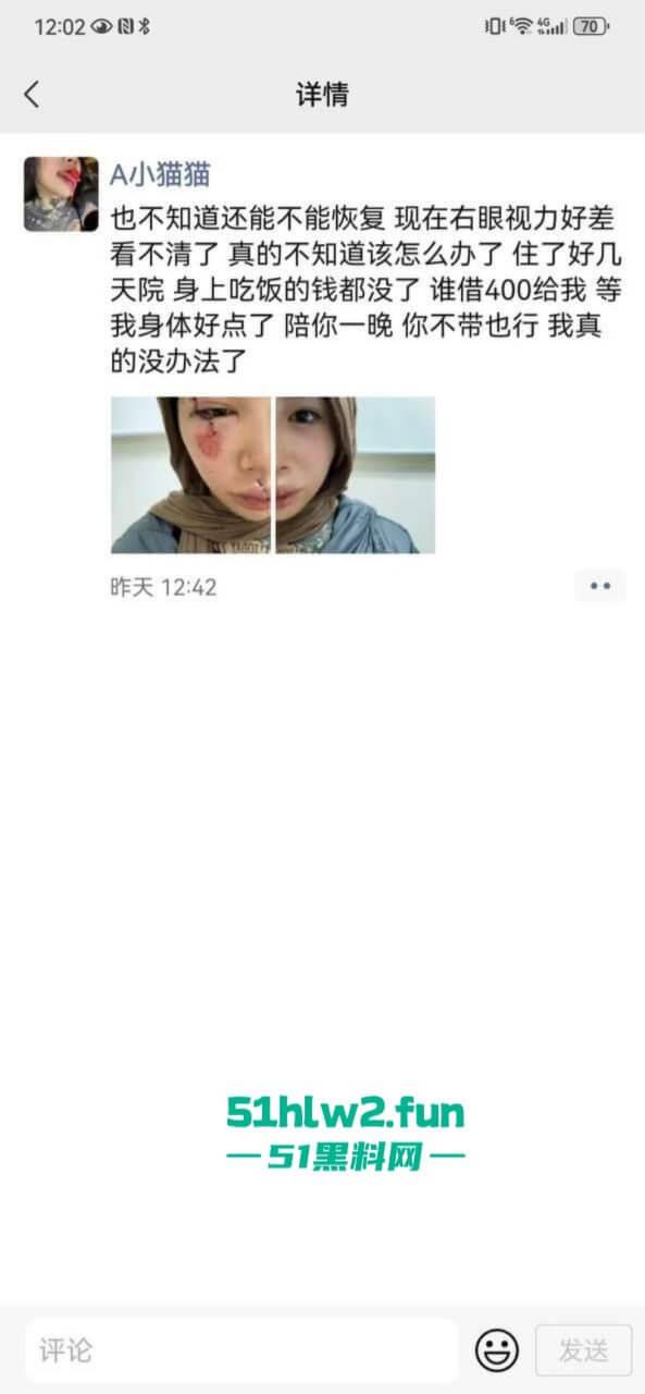 卖惨惯犯纹身妹，骑电瓶车出车祸惨遭破相朋友圈无奈卖身求钱就医，骚货的卖身已成习惯。-5