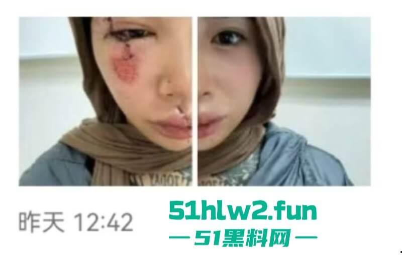 卖惨惯犯纹身妹，骑电瓶车出车祸惨遭破相朋友圈无奈卖身求钱就医，骚货的卖身已成习惯。-6